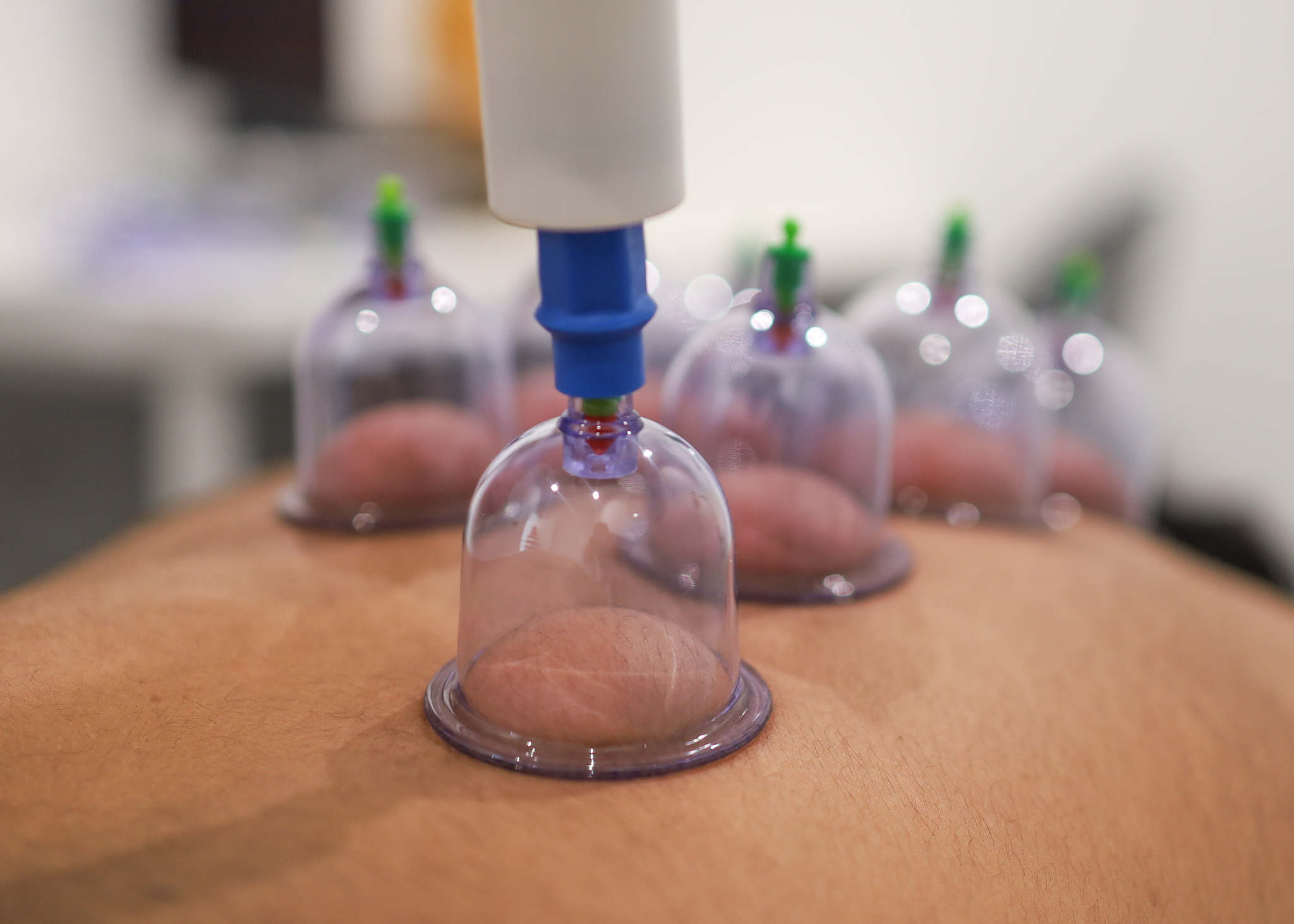 Cupping Therapy